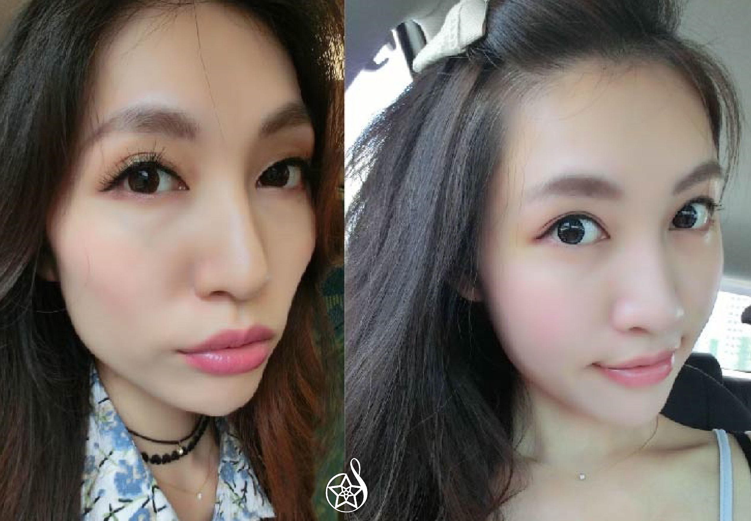 自體脂肪填補好面相美顏術｜用身體過多脂肪，打造名媛專屬好命臉！